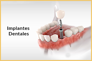 Implantes Dentales Turquia